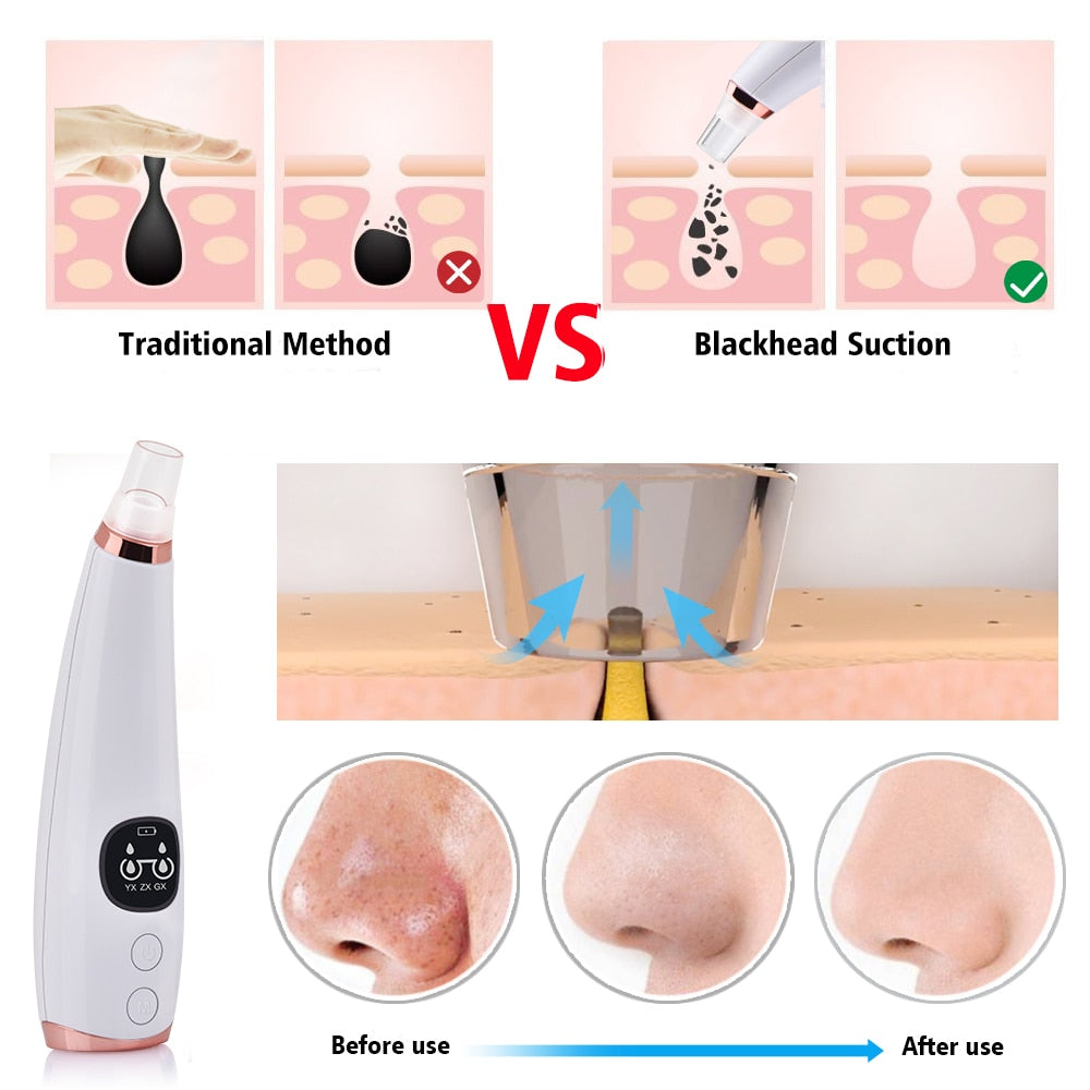 Blackhead Extractor